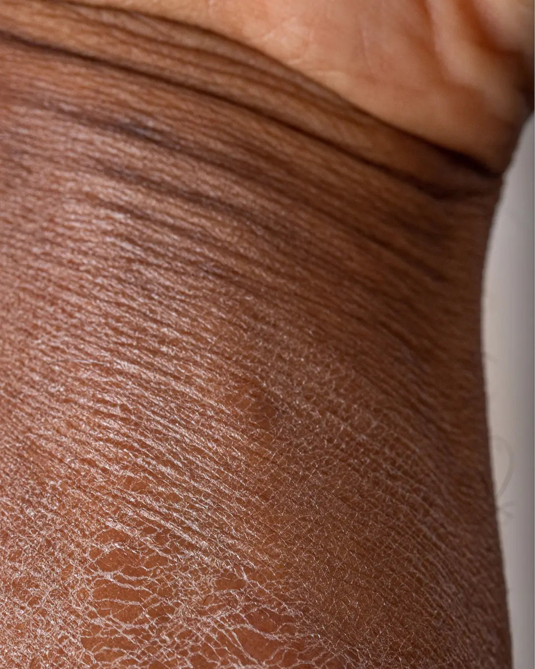 Dry vs. Dehydrated Skin - Understanding the Difference and How to